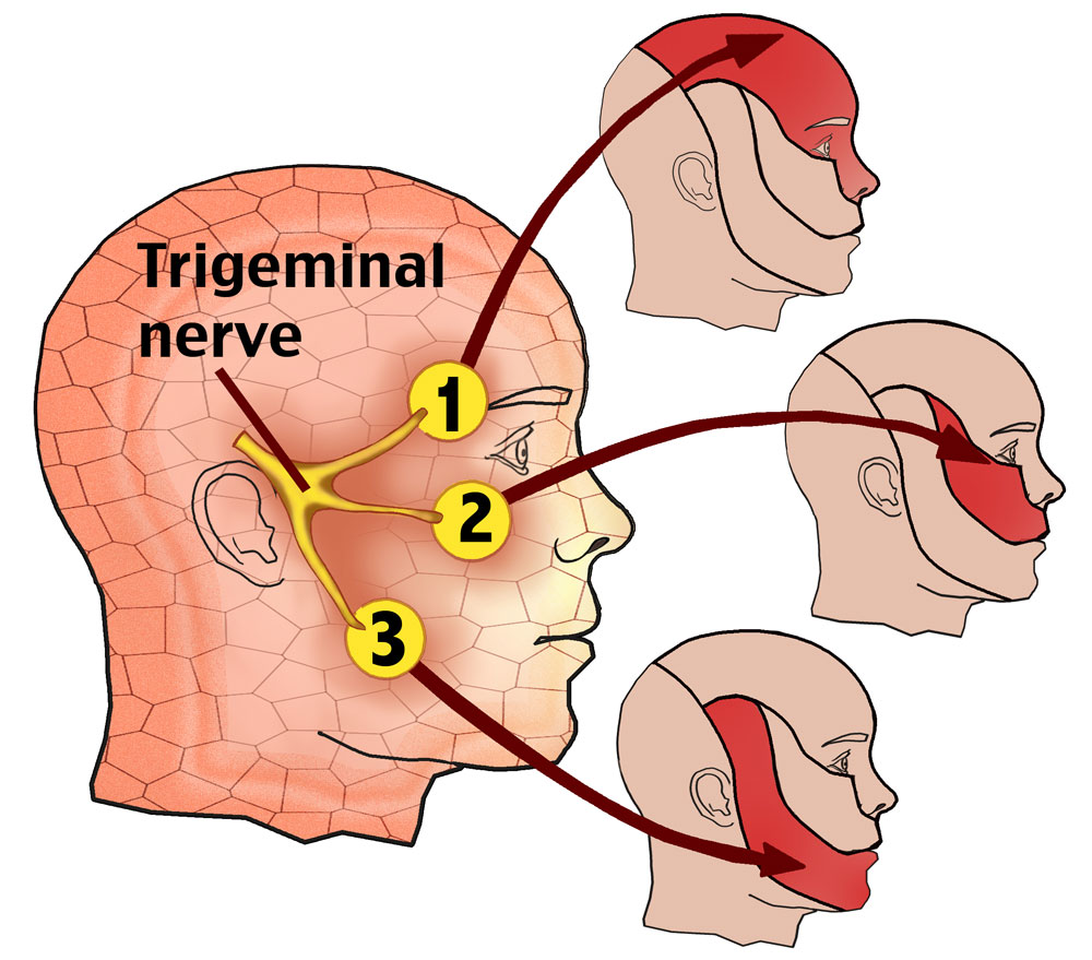 دوره آموزشی تحریک عصب تری ژمینال - مدرسه طب